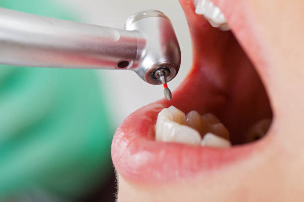 Best Knocked-Out Tooth (Avulsed Tooth) Treatment in Poplar Plains, CT